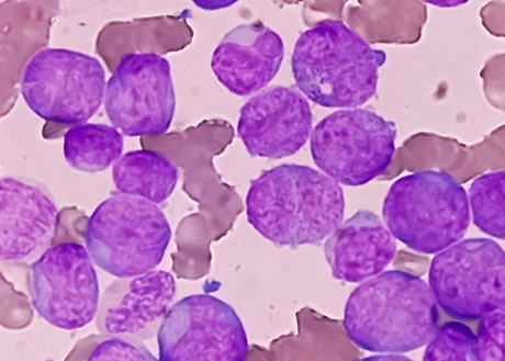 Acute Myeloid Leukemia under microscope