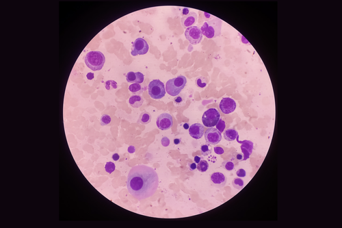 refractory multiple myeloma