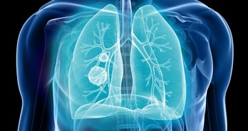 Early-Stage Non-small Cell Lung Cancer