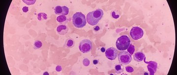 An image of multiple myeloma cells