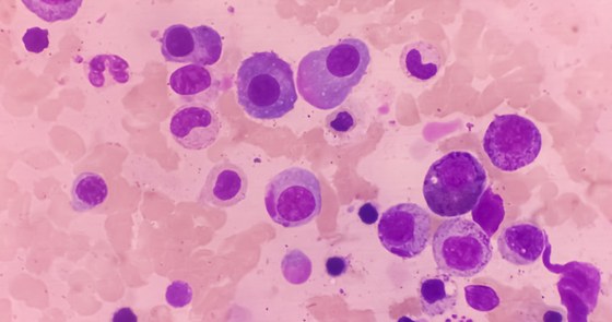 An image of multiple myeloma cells
