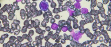 An image of acute lymphoblastic leukemia cells