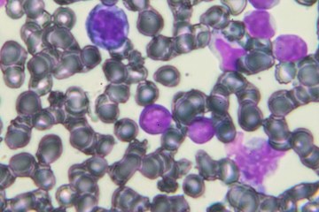 An image of acute lymphoblastic leukemia cells