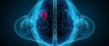 An image of a brain x-ray