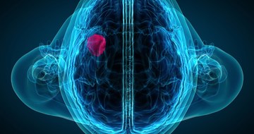 An image of a brain x-ray