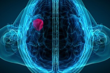 An image of a brain x-ray