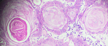 Squamous cell carcinoma
