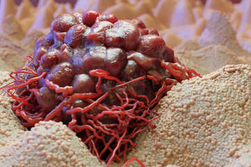 Cancer cell image