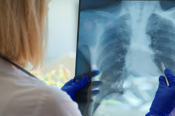 Lung cancer x-ray image