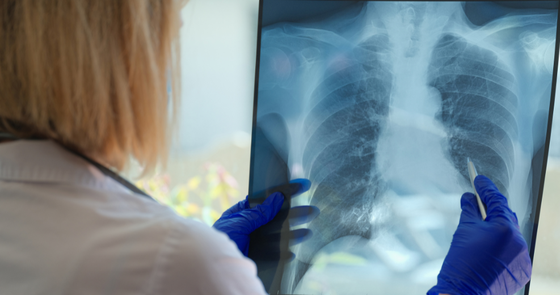 Lung cancer x-ray image