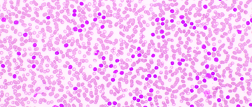acute leukemia image