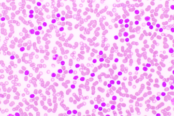 acute leukemia image
