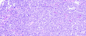 Diffuse large B-cell lymphoma