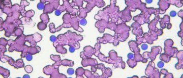 An image of chronic lymphocytic leukemia cells under a microscope
