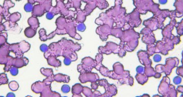 An image of chronic lymphocytic leukemia cells under a microscope