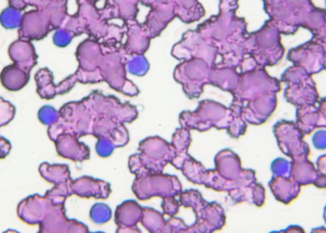 An image of chronic lymphocytic leukemia cells under a microscope