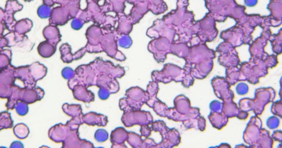 An image of chronic lymphocytic leukemia cells under a microscope