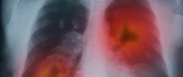 Lungs with cancer