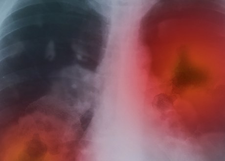 Lungs with cancer