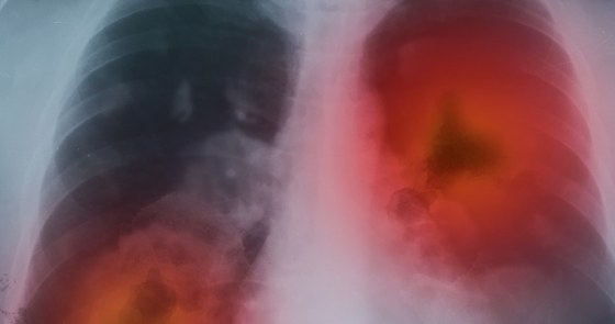 Lungs with cancer