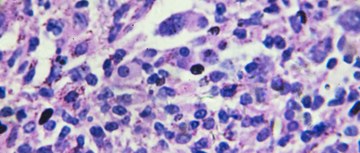 An image of Non-Hodgkin's lymphoma cells