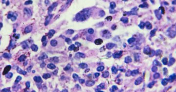 An image of Non-Hodgkin's lymphoma cells