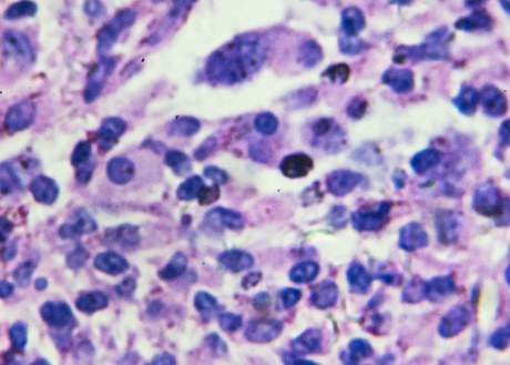 An image of Non-Hodgkin's lymphoma cells