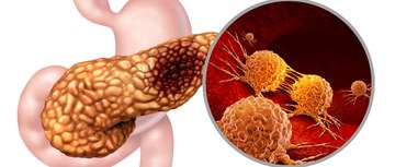 An image of pancreatic cancer