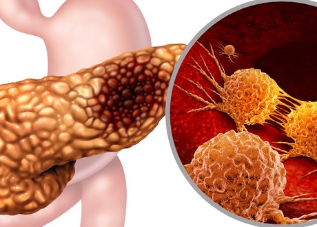 An image of pancreatic cancer