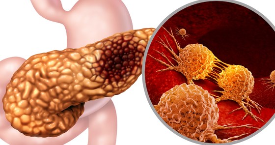An image of pancreatic cancer