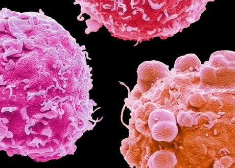 An image of colorectal cancer cells