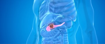 A graphic of pancreatic cancer