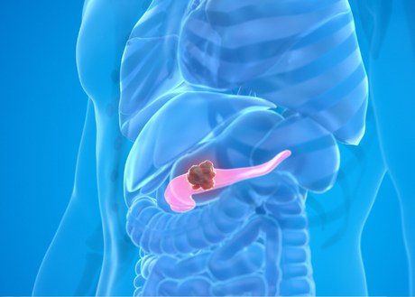 A graphic of pancreatic cancer