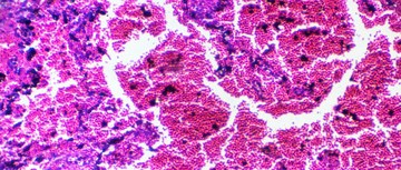 An image of pneumonitis cells