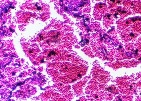An image of pneumonitis cells