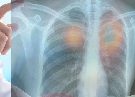 An image of a doctor looking at an x-ray of lungs with cancer