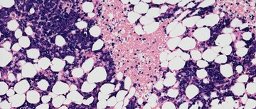 An image of multiple myeloma cells