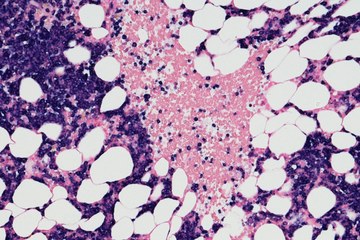 An image of multiple myeloma cells