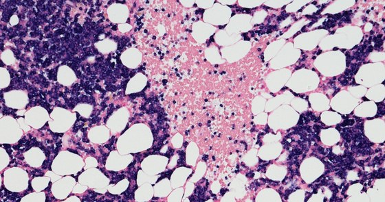 An image of multiple myeloma cells