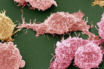 metastatic non-small cell lung cancer