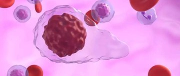 Myelofibrosis with anemia