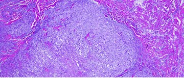 uveal melanoma with unresectable hepatic metastases