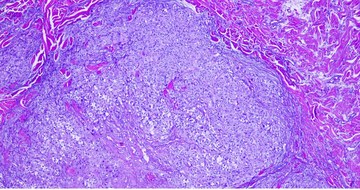 uveal melanoma with unresectable hepatic metastases