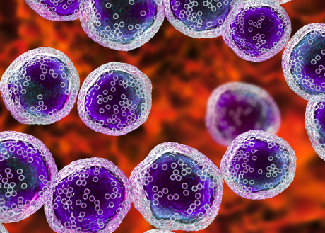 Large B-Cell Lymphoma