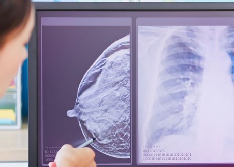 Woman pointing to x-ray of metastatic breast cancer diagram