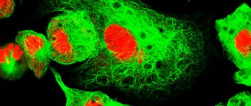 high-risk neuroblastoma