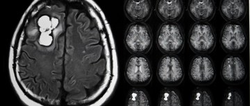 X-ray of brain with desmoid tumors