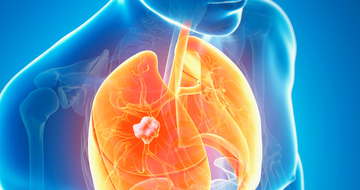 digital medical illustration of lung cancer in a person's chest